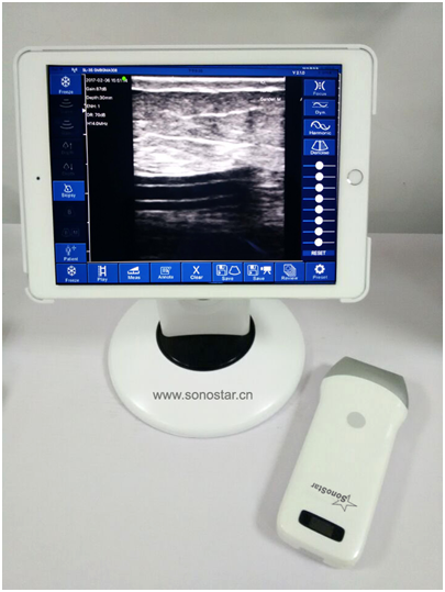 Clinical Application of Wireless Portable Ultrasound in the Diagnosis and Treatment of Anesthesia an